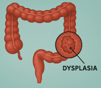 ibd